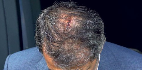 Şenol Güneş, Malatyaspor Maçına Başında Dikişlerle Çıktı