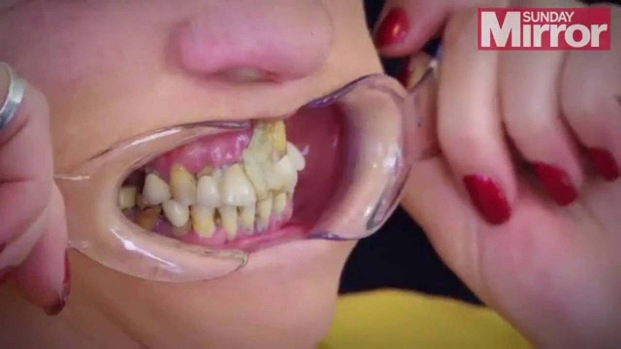 Elle se recolle les dents à la glue pour éviter d'aller chez le dentiste, tellement elle en a peur