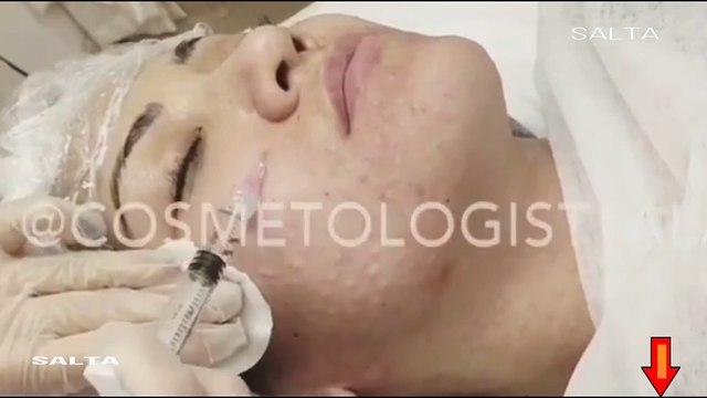 girl botox face botoks videos video / fille botox visage botoks vidéos