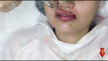 video girl enlarge the lips of Botox Botulinum toxin / agrandir les lèvres de Botox maquillage fille vidéo