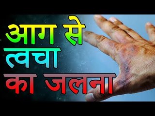 जली हुई त्वचा के जलन अाैर दाग को खत्म करने के नुस्खे | Health Tips