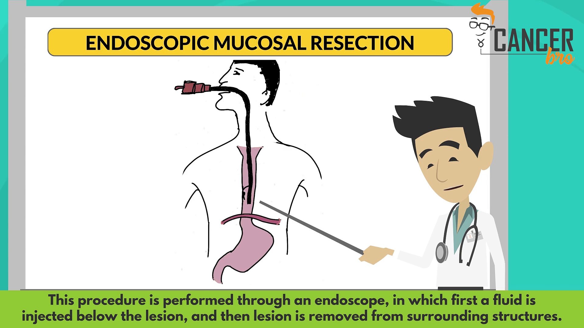 Treatment of localised and locally advanced esophageal cancer
