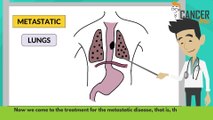 Treatment of metastatic esophageal cancer [Stage 4]