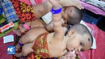 Gemelos unidos por pygopagus son separados en Bangladesh