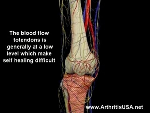 Patellar tendonitis or Jumper