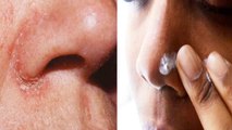 Nose Dry Skin Remedies | नाक की खाल उतरने पर अपनाएं ये तरीक़े | Boldsky