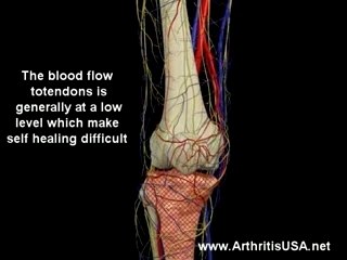Patellar tendonitis or Jumper