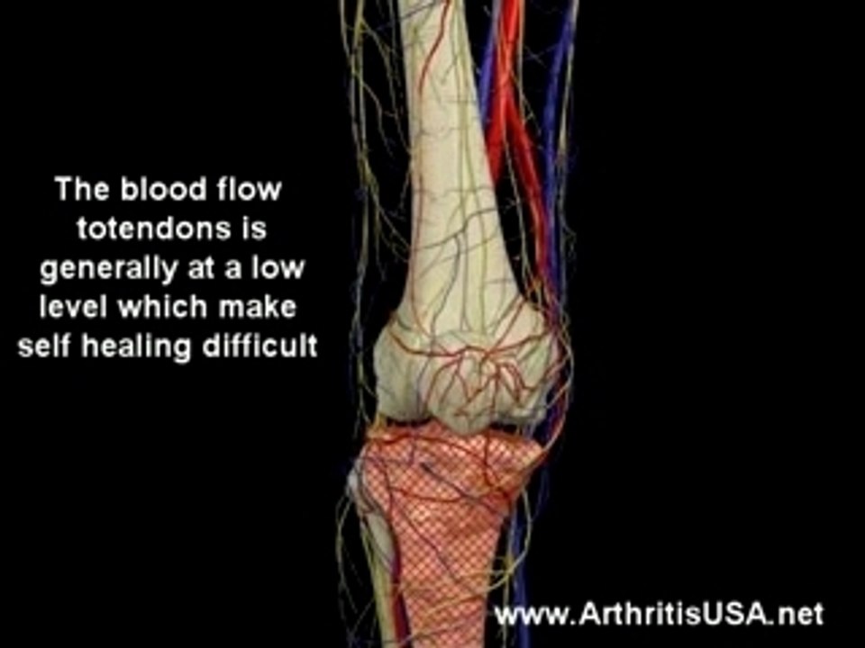 Patellar tendonitis or Jumper