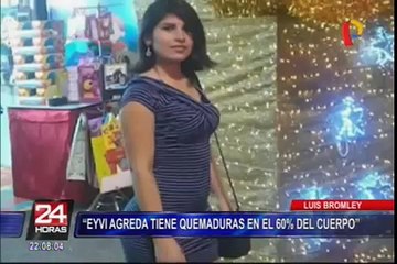 EsSalud se pronuncia sobre estado de salud de joven quemada en bus