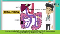 Metastatic colon cancer treatment