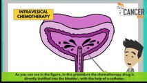 Non metastatic bladder cancer treatment explained by CancerBro