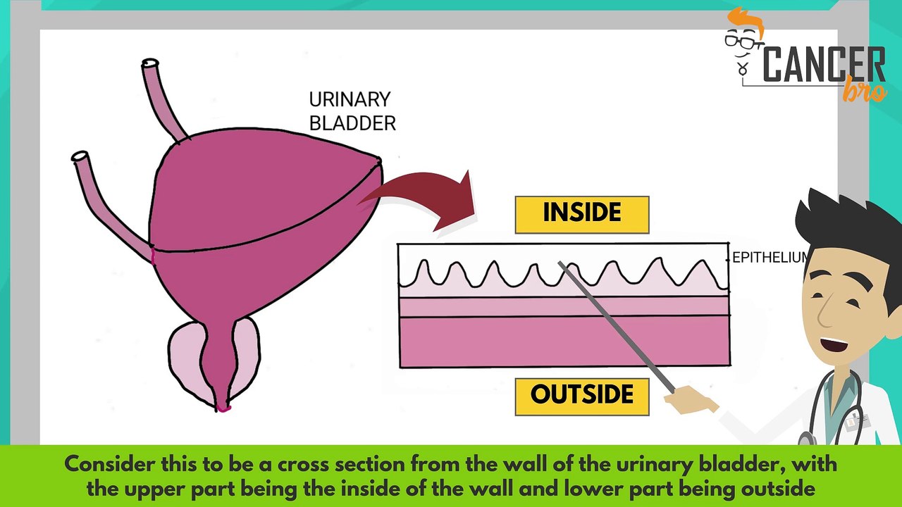Bladder cancer TNM staging explained
