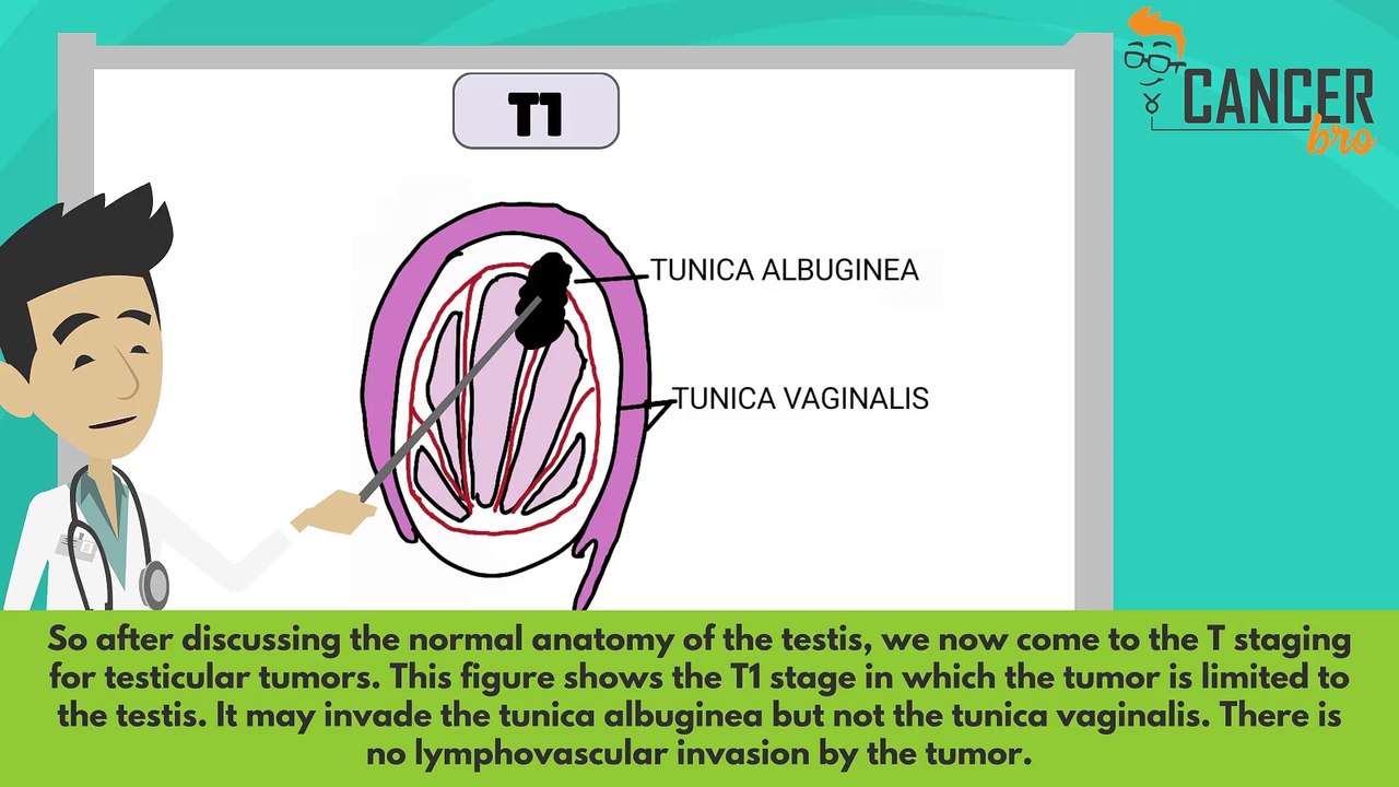 TNM testicular cancer staging