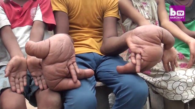 Cet enfant a des mains géantes - Maladie impressionnante