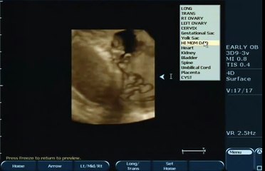 سونار الحمل الاسبوع الحادي عشر