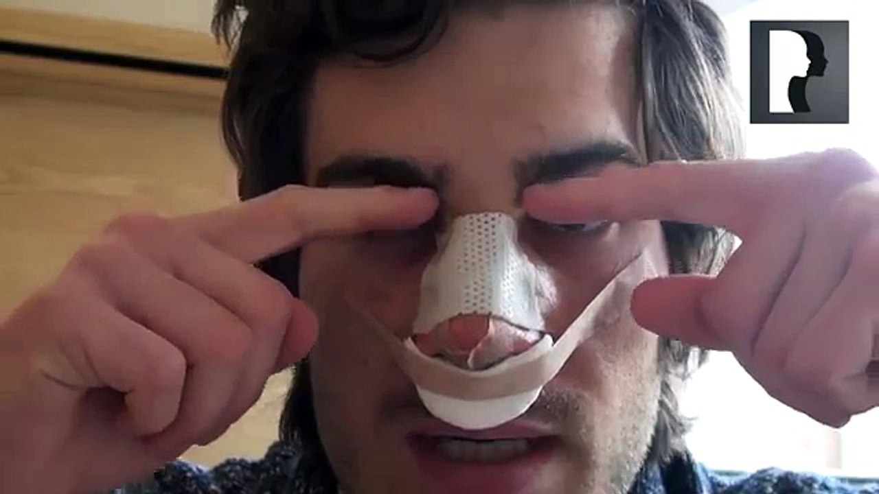 2 Male Rhinoplasty Nose Job Diary Day 1 After Surgery
