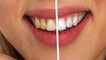Teeth Whitening | अगर आप भी दांतों को ब्लीच करना चाहतें है, तो जरूर देखें ये वीडियो | Boldsky