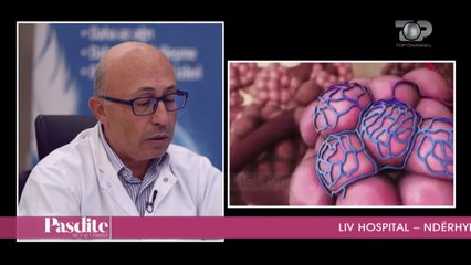 Pasdite ne TCH, Kirurgjia torakale ne Liv Hospital, 3 Tetor 2017, Pjesa 4