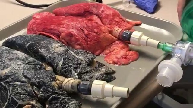 Poumons de fumeur vs Poumons sains