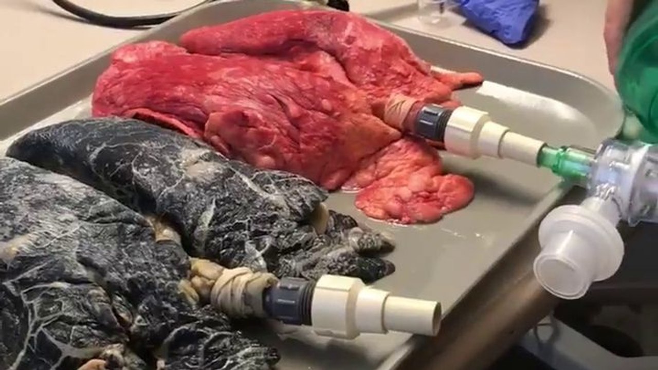 Poumons de fumeur vs Poumons sains