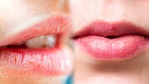 Dark Lips: Reasons | आपके होंठ भी हो जातें हैं काले, ये होती हैं बड़ी वजह | Boldsky
