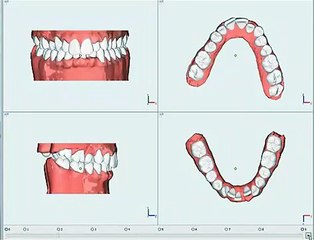 Clearfix Tedavi Simülasyonu - Çekimli Tedavi