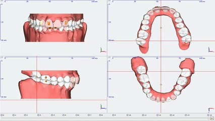 Clearfix Tedavi Simülasyonu - Çarpışıklık