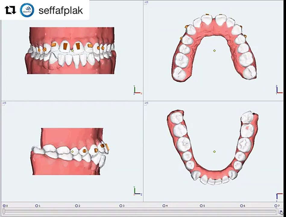 Clearfix Tedavi Simülasyonu - Açık Kapanış