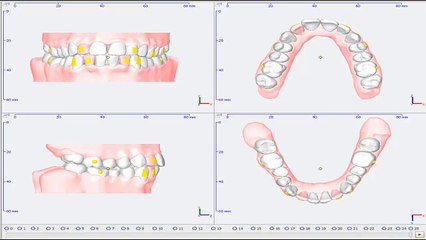 Clearfix Tedavi Simülasyonu - Dar Ark