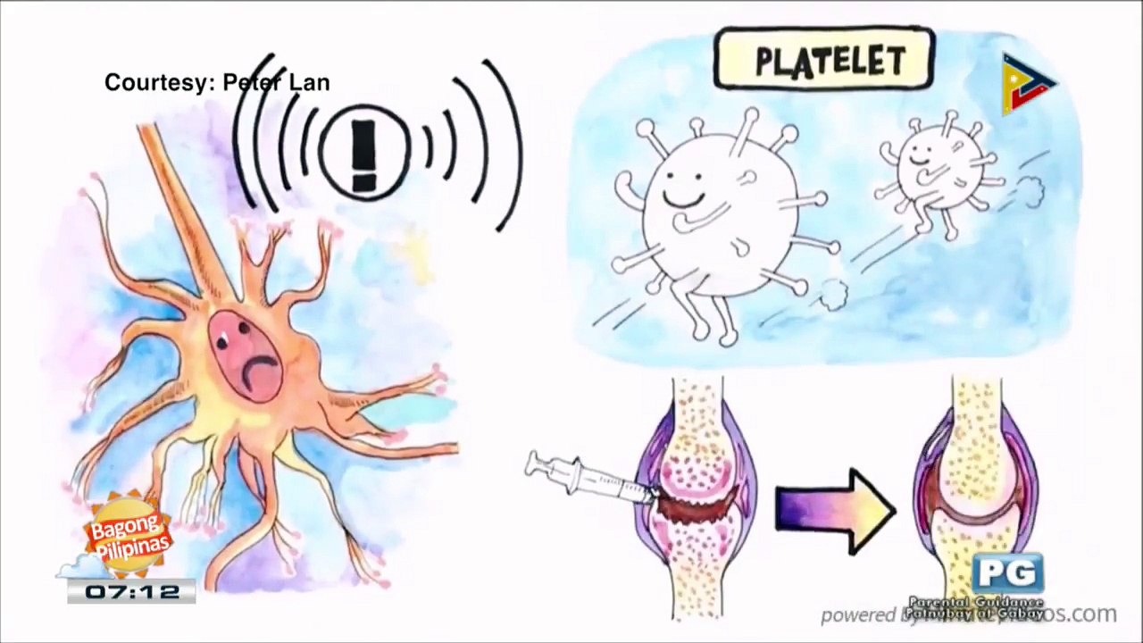 DERMAESTHETIQUE: Forehead augmentation with platelet rich plasma (PRP)
