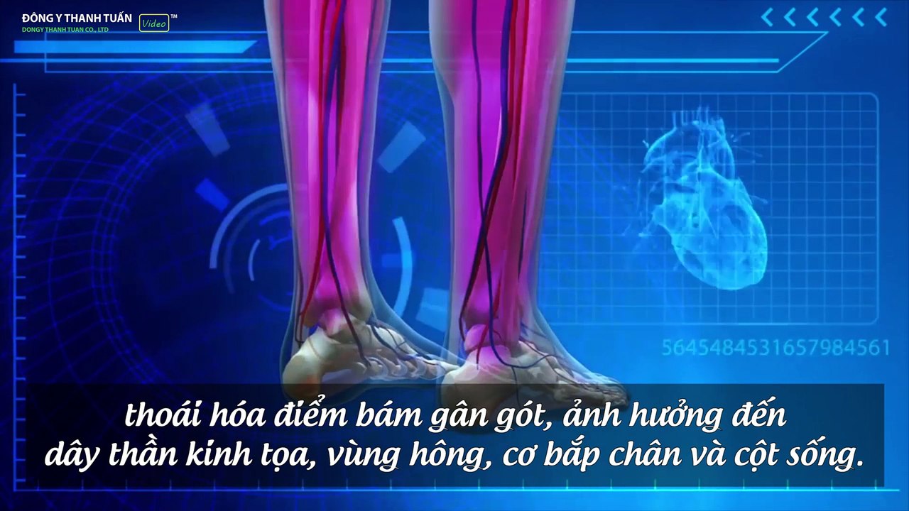 Tìm hiểu về bệnh gai gót chân và cách chữa trị