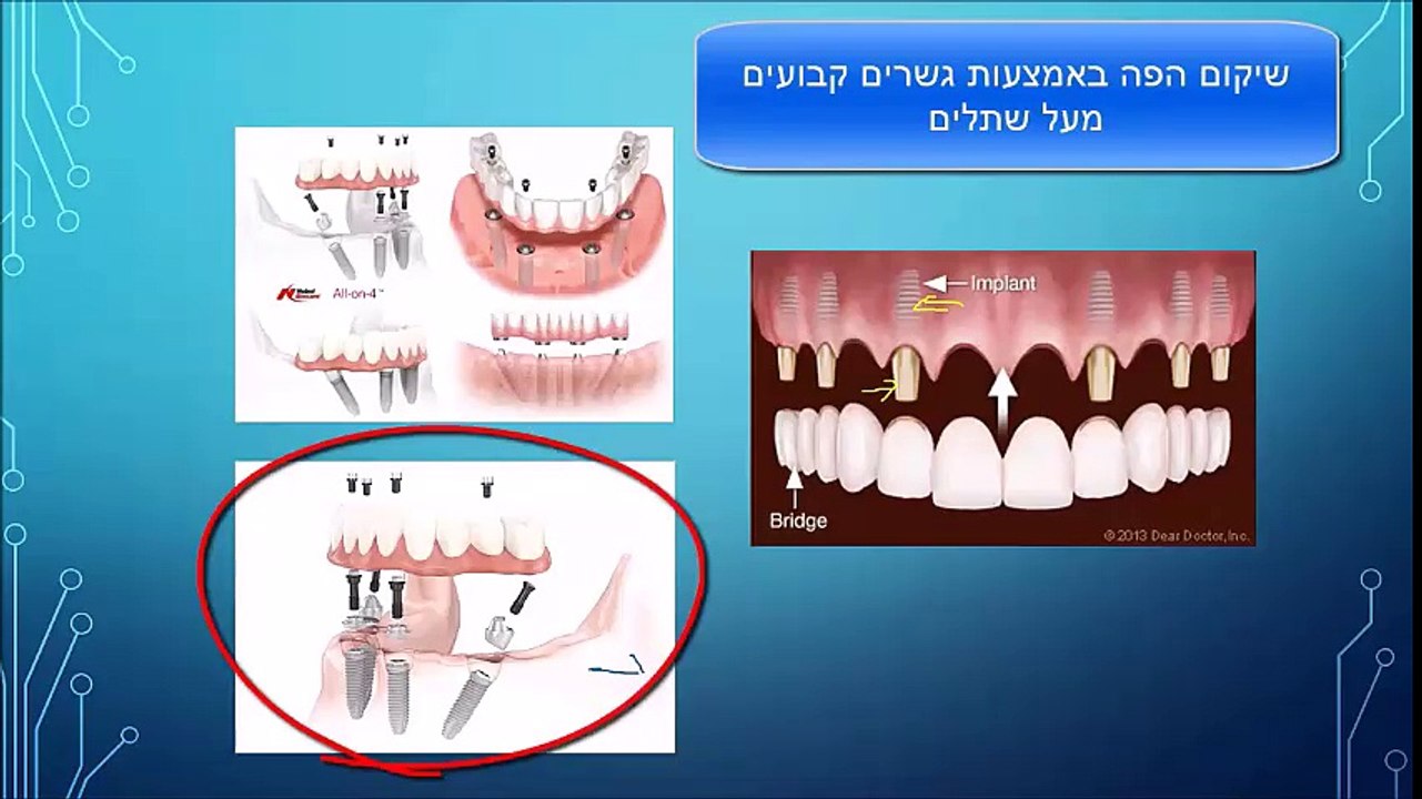 מאיר אבירם -  סוגי השתלות שיניים ומחיריהן - חלק  2