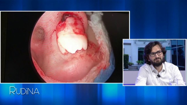 Rudina - Spitali Amerikan/Nxjerrja nga veshi e trupave të huaj! (08 nentor 2017)