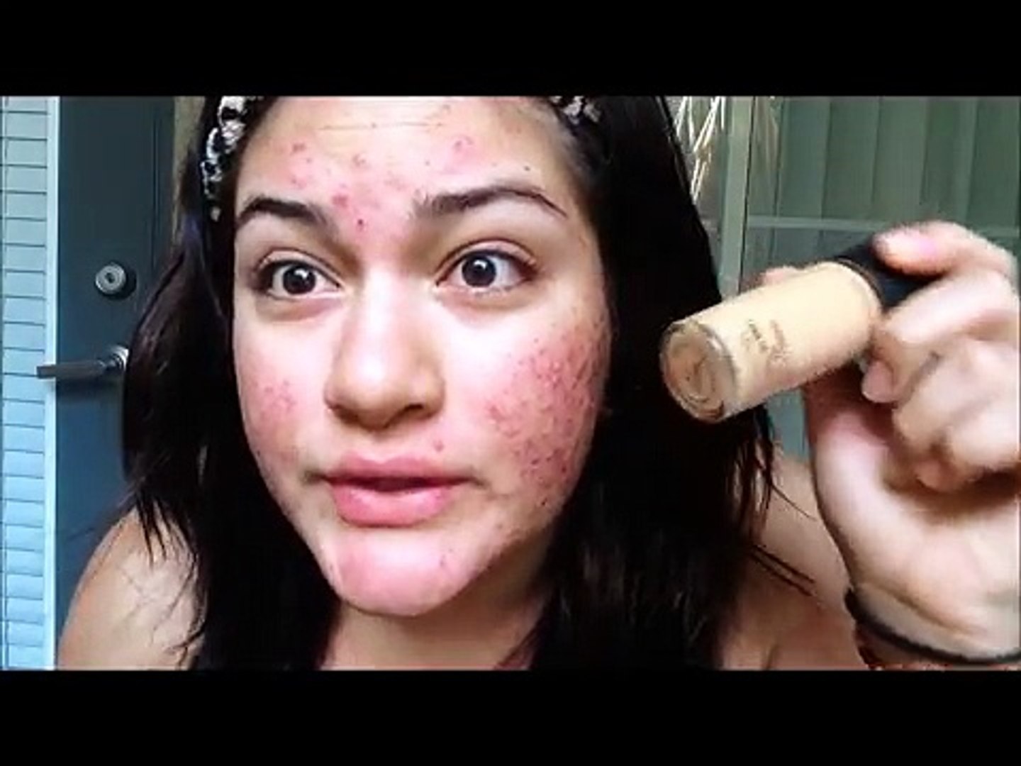 MAC Studio Fix Fluid Foundation: DEMO + REVIEW ON ACNE SKIN [FULL COVERAGE]  - video dailymotion