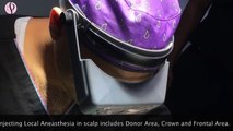 Hair Transplant in India