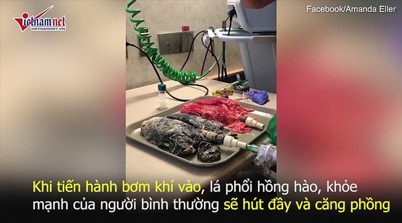 Sốc với video lá phổi đen sì, khò khè vì bị thuốc lá tàn phá
