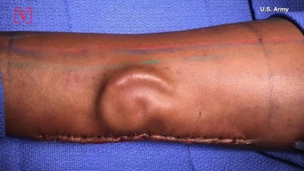 Army Doctors 'Grow' New Ear for Soldier Inside Her Arm