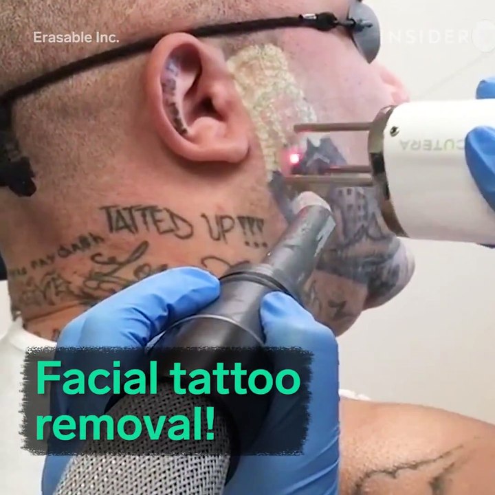 Amazing Laser Tattoo Remove Every Hard or Complex Tatoo