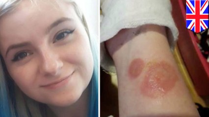 Deodorant Challenge leaves UK teen with second-degree burns