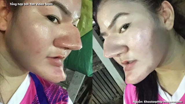 Dung mạo kinh dị do phẩu thuật thẫm mỹ quá lố của cô gái ở Thái Lan