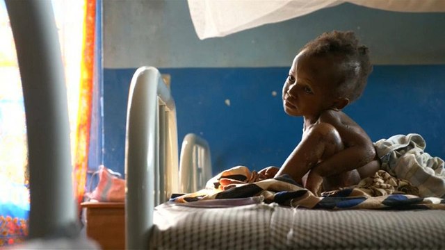 Unicef: Congo, oltre 700.000 bambini soffrono di malnutrizione