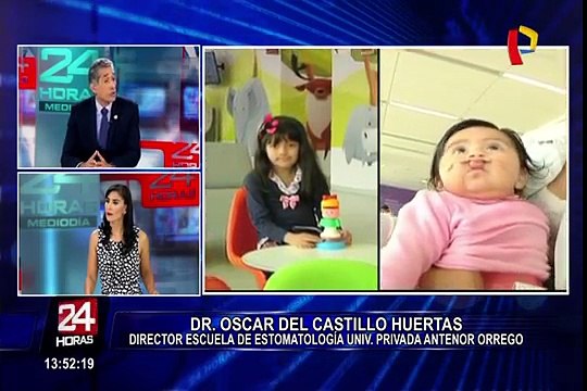 UPAO realizaran campaña de operaciónes de labio leporino y paladar hendido