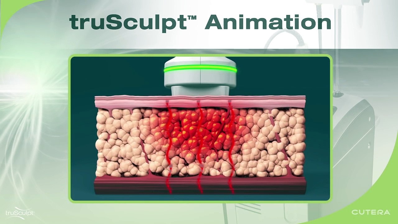 truSculpt Video