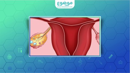 تكيس المبايض والحمل