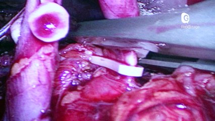 Reportage - Une greffe de rein au CHUGA