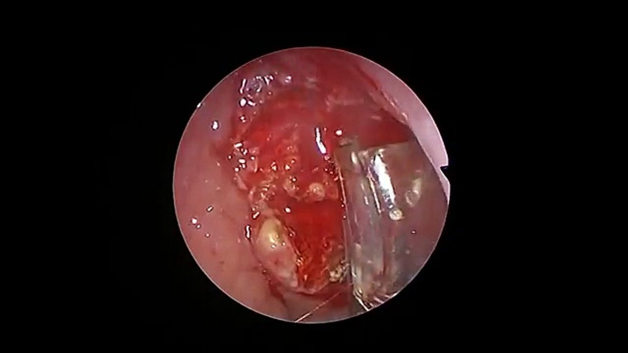 Modern Adenoid Surgery