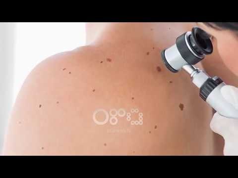 Ora News - Tumori i lëkurës, mjekët japin alarmin: 13 raste në muaj