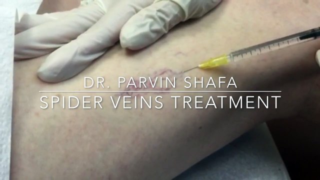 Spider Veins and Varicose Veins Treatment | Irvine Skin
