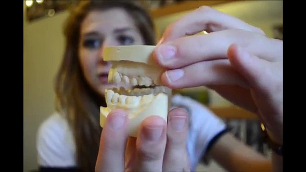 TWIN BLOCK BRACES
