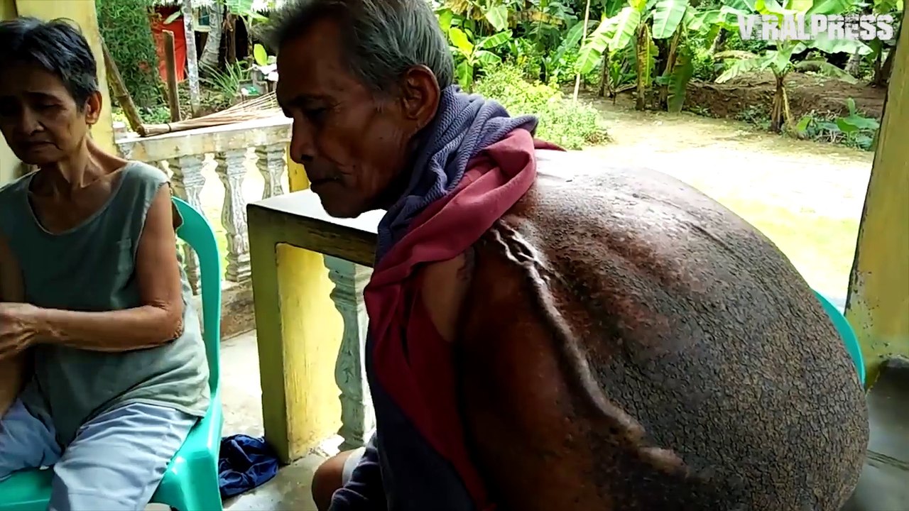 Pensioner With Large Back Growth